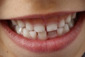 picture of kids teeth for the purpose of showing and education about oral appliances
