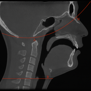chat gpt image of a scan of a skull showing wide airway