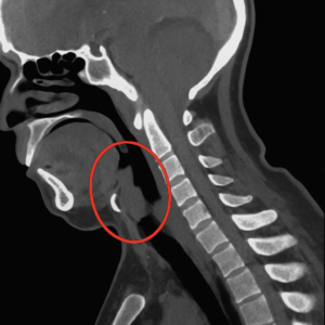 chat gpt image of a scan with a narrow airway tube