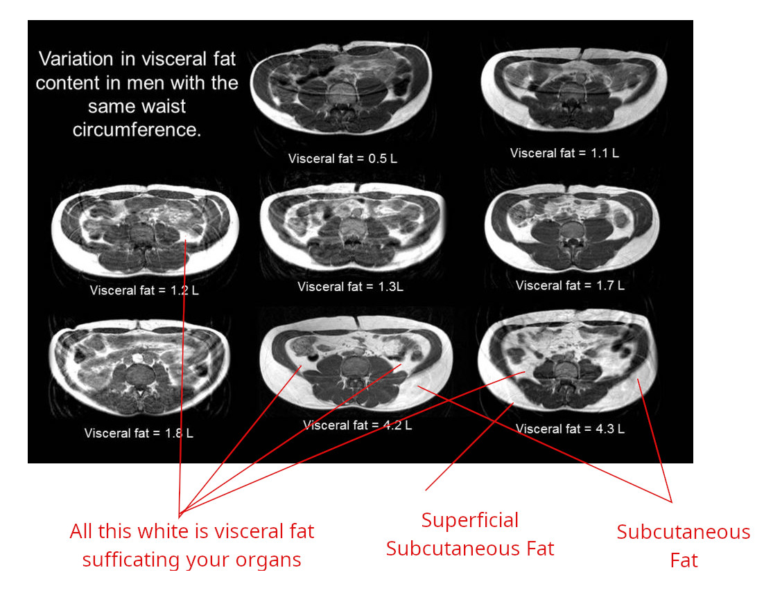 "File:Variation in visceral fat in men with the same waist circumference.jpg" by ImagingFat, Modifications: Drew lines and labled corresponding fat is licensed under CC BY-SA 4.0